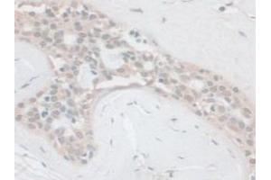 IHC-P analysis of Human Breast Cancer Tissue, with DAB staining. (PCSK1 anticorps  (AA 500-738))