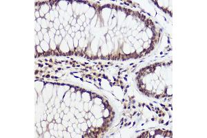 Immunohistochemistry of paraffin-embedded human colon carcinoma using WBP11 Rabbit pAb (ABIN7271390) at dilution of 1:100 (40x lens).