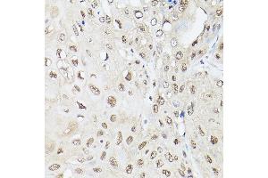Immunohistochemistry of paraffin-embedded human esophageal cancer using UBQLN2 Rabbit pAb (ABIN6127815, ABIN6149859, ABIN6149860 and ABIN6225041) at dilution of 1:250 (40x lens).