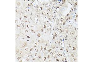 Immunohistochemistry of paraffin-embedded human esophageal cancer using UBQLN2 Rabbit pAb (ABIN6127815, ABIN6149859, ABIN6149860 and ABIN6225041) at dilution of 1:250 (40x lens). (Ubiquilin 2 anticorps  (AA 1-150))
