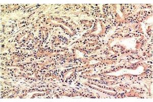 Immunohistochemistry of paraffin-embedded Human stomach carcinoma tissue using CHOP Monoclonal Antibody at dilution of 1:200. (DDIT3 anticorps)