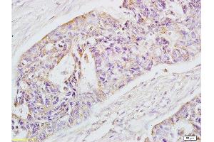 Formalin-fixed and paraffin-embedded human rectal carcinoma labeled with Rabbit Anti-EpCAM Polyclonal Antibody , Unconjugated 1:200 followed by conjugation to the secondary antibody and DAB staining (EpCAM anticorps  (AA 221-314))