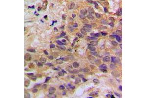 Immunohistochemical analysis of p53 (pS37) staining in human breast cancer formalin fixed paraffin embedded tissue section. (p53 anticorps  (N-Term, pSer37))