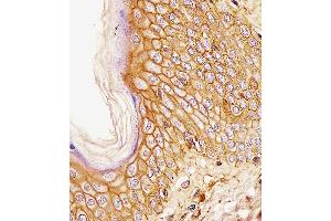 CD44 antibody (ABIN659120 and ABIN2843760) immunohistochemistry analysis in formalin fixed and paraffin embedded human esophagus carcinoma followed by peroxidase conjμgation of the secondary antibody and DAB staining. (CD44 anticorps)