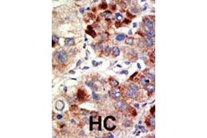 Formalin-fixed and paraffin-embedded human hepatocellular carcinoma tissue reacted with AR polyclonal antibody , which was peroxidase-conjugated to the secondary antibody, followed by DAB staining. (Androgen Receptor anticorps)