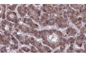 ABIN6273923 at 1/100 staining Human liver cancer tissue by IHC-P. (CCKBR anticorps  (N-Term))
