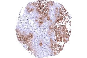 Esophageal squamous cell carcinoma with moderate to strong PAI2 positivity of intermediate and superficial tumor cell layers (Recombinant SERPINB2 anticorps)