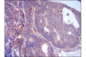 Immunohistochemical analysis of paraffin-embedded rectum cancer tissues using PLIN2 mouse mAb with DAB staining.
