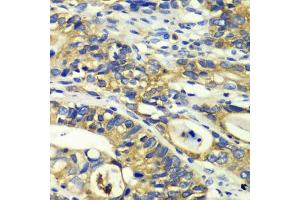 Immunohistochemistry of paraffin-embedded human colon carcinoma using RPH3A antibody (ABIN6128668, ABIN6147094, ABIN6147096 and ABIN6217639) at dilution of 1:100 (40x lens). (RPH3A anticorps  (AA 1-280))