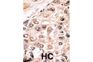 Formalin-fixed and paraffin-embedded human cancer tissue reacted with the primary antibody, which was peroxidase-conjugated to the secondary antibody, followed by AEC staining.