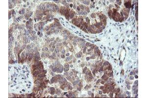 Immunohistochemical staining of paraffin-embedded Adenocarcinoma of Human ovary tissue using anti-TBCC mouse monoclonal antibody. (TBCC anticorps)