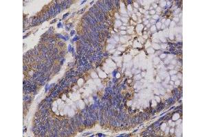 Immunohistochemistry of paraffin-embedded Human rectum cancer using EPHX2 Polyclonal Antibody at dilution of 1:200 (40x lens). (EPHX2 anticorps)