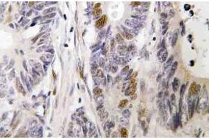 Immunohistochemistry (IHC) analyzes of c-Fos antibody in paraffin-embedded human colon carcinoma tissue. (c-FOS anticorps)