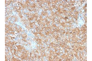 Formalin-fixed, paraffin-embedded human Prostate Carcinoma stained with CD63 Rabbit Recombinant Monoclonal Antibody (LAMP3/2990R). (Recombinant CD63 anticorps)