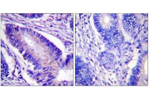 Immunohistochemistry analysis of paraffin-embedded human colon carcinoma tissue using eIF4B (Phospho-Ser422) antibody. (EIF4B anticorps  (pSer422))