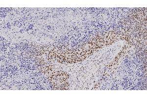 Human squamous cell carcinoma: immunohistochemical staining for mismatch repair protein (MLH1).