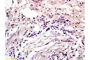 Formalin-fixed and paraffin embedded human colon carcinoma labeled with Anti-CD45RO Polyclonal Antibody, Unconjugated (ABIN733283) at 1:200 followed by conjugation to the secondary antibody and DAB staining (CD45RO anticorps)