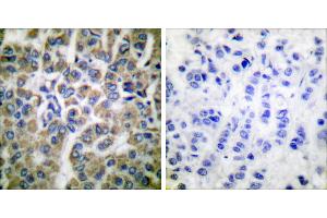 Peptide - +Immunohistochemical analysis of paraffin-embedded human breast carcinoma tissue using HSP10 antibody (#C0230). (HSPE1 anticorps)