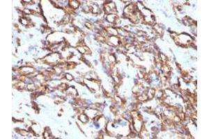 Immunohistochemical staining (Formalin-fixed paraffin-embedded sections) of human angiosarcoma with VIM monoclonal antibody, clone VM1170 . (Vimentin anticorps)