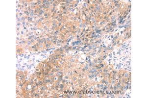 Immunohistochemistry of Human breast cancer using SNAP23 Polyclonal Antibody at dilution of 1:25 (SNAP23 anticorps)