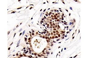 Immunohistochemistry analysis of paraffin-embedded human breast cancer using HDAC1 Polyclonal Antibody at dilution of 1:300. (HDAC1 anticorps)