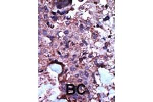Formalin-fixed and paraffin-embedded human cancer tissue reacted with the primary antibody, which was peroxidase-conjugated to the secondary antibody, followed by AEC staining.