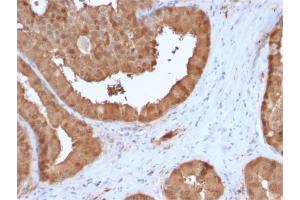 Formalin-fixed, paraffin-embedded human Prostate Carcinoma stained with Lactoylglutathione Lyase Mouse Monoclonal Antibody (CPTC-GLO1-3). (GLO1 anticorps)