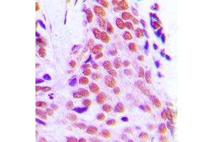 Immunohistochemical analysis of RPL28 staining in human breast cancer formalin fixed paraffin embedded tissue section.