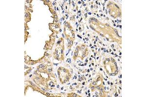 Immunohistochemistry of paraffin-embedded human kidney cancer using ARRB2 antibody at dilution of 1:200 (400x lens).