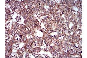 Immunohistochemical analysis of paraffin-embedded esophageal cancer tissues using CAV2 mouse mAb with DAB staining.
