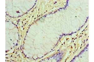 Immunohistochemistry of paraffin-embedded human colon cancer using ABIN7153892 at dilution of 1:100 (GCKR anticorps  (AA 1-625))