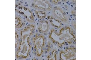 Immunohistochemistry of paraffin-embedded human kidney cancer using TNFRSF6B antibody (ABIN5970241) at dilution of 1/200 (40x lens). (TNFRSF6B anticorps)