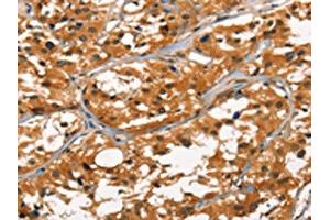 The image on the left is immunohistochemistry of paraffin-embedded Human thyroid cancer tissue using ABIN7190457(DEFA1/3 Antibody) at dilution 1/30, on the right is treated with synthetic peptide. (DEFA1/DEFA3 anticorps)