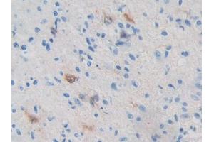 DAB staining on IHC-P; Samples: Human Glioma Tissue (PRKAB2 anticorps  (AA 17-260))