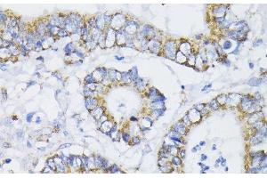 Immunohistochemistry of paraffin-embedded Human colon carcinoma using PDHA1 Polyclonal Antibody at dilution of 1:200 (40x lens). (PDHA1 anticorps)