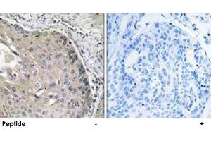 Immunohistochemistry analysis of paraffin-embedded human lung carcinoma tissue, using AOX1 polyclonal antibody . (AOX1 anticorps)