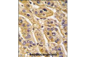 Formalin-fixed and paraffin-embedded human hepatocarcinoma tissue reacted with HIBCH antibody , which was peroxidase-conjugated to the secondary antibody, followed by DAB staining.