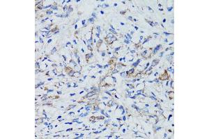 Immunohistochemistry of paraffin-embedded human uterine cancer using USO1 antibody (ABIN1875291) at dilution of 1:100 (40x lens). (USO1 anticorps)