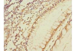 Immunohistochemistry of paraffin-embedded human colon cancer using ABIN7160425 at dilution of 1:100 (MPZL2 anticorps  (AA 30-140))