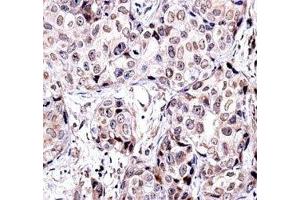 SIRT6 antibody immunohistochemistry analysis in formalin fixed and paraffin embedded human breast carcinoma.