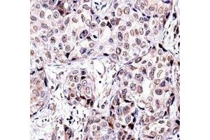 SIRT6 antibody immunohistochemistry analysis in formalin fixed and paraffin embedded human breast carcinoma. (SIRT6 anticorps  (AA 276-305))