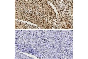 CTCF antibody (pAb) tested by Immunohistochemistry Nuclear staining pattern is detected in Formalin-fixed, paraffin-embedded tissue sections from human breast carcinoma. (CTCF anticorps  (N-Term))
