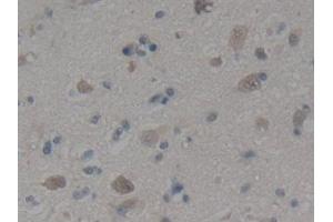 Detection of BMP9 in Human Glioma Tissue using Polyclonal Antibody to Bone Morphogenetic Protein 9 (BMP9) (GDF2 anticorps  (AA 32-427))