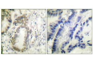 Immunohistochemical analysis of paraffin-embedded human colon carcinoma tissue using C/EBP-α (phospho-Ser21) antibody (left)or the same antibody preincubated with blocking peptide (right).