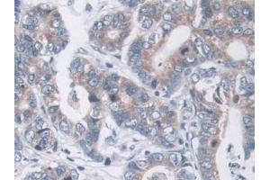 Detection of MOSC1 in Human Stomach cancer Tissue using Polyclonal Antibody to MOCO Sulphurase C-Terminal Domain Containing Protein 1 (MOSC1) (MOSC1 anticorps  (AA 41-335))