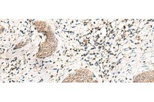 Immunohistochemistry of paraffin-embedded Human esophagus cancer tissue using SNRPG Polyclonal Antibody at dilution of 1:40(x200) (SNRPG anticorps)