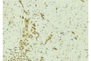 ABIN6277007 at 1/100 staining Human breast cancer tissue by IHC-P. (SMARCA5 anticorps  (C-Term))