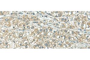 Immunohistochemistry of paraffin-embedded Human liver cancer tissue using KCNJ2 Polyclonal Antibody at dilution of 1:25(x200)