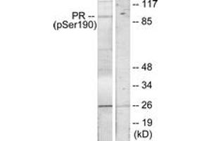 Immunohistochemistry analysis of paraffin-embedded human breast carcinoma, using Progesterone Receptor (Phospho-Ser190) Antibody. (Progesterone Receptor anticorps  (pSer190))