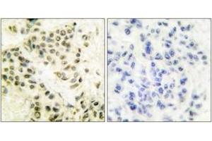 Immunohistochemistry analysis of paraffin-embedded human breast carcinoma tissue, using DNA-PK Antibody. (PRKDC anticorps  (AA 4061-4110))